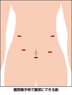 腹腔鏡下手術で腹部にできる創