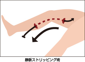 静脈ストリッピング術